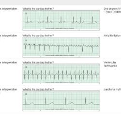 Relias advanced dysrhythmia exam a