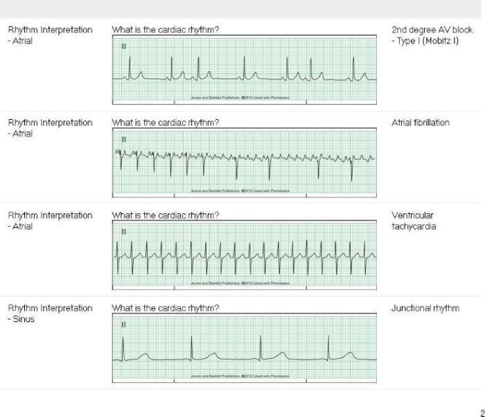 Relias advanced dysrhythmia exam a