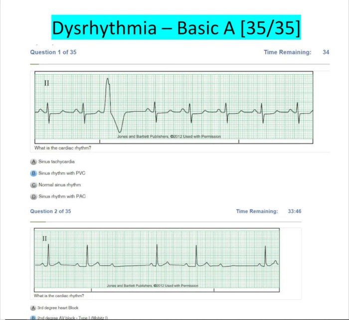 Relias advanced dysrhythmia exam a